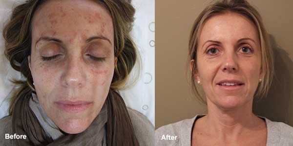 TCA chemical peel before and after photos